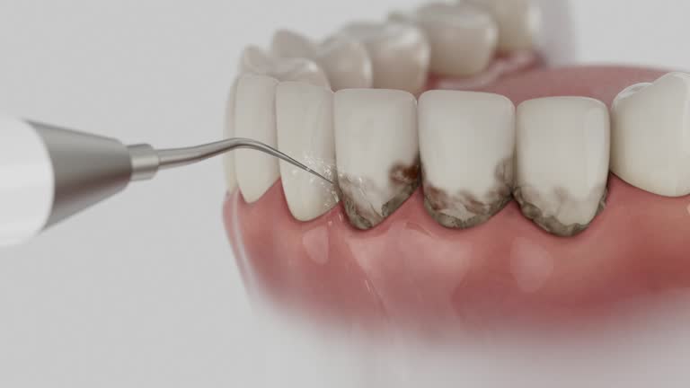 Trusted Wisdom Tooth Removal service in Marion, IN - Dentist Open Now